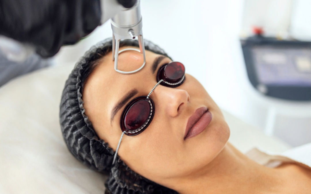 Erbium Laser Resurfacing Costs in Rockville, Maryland for Acne Scars